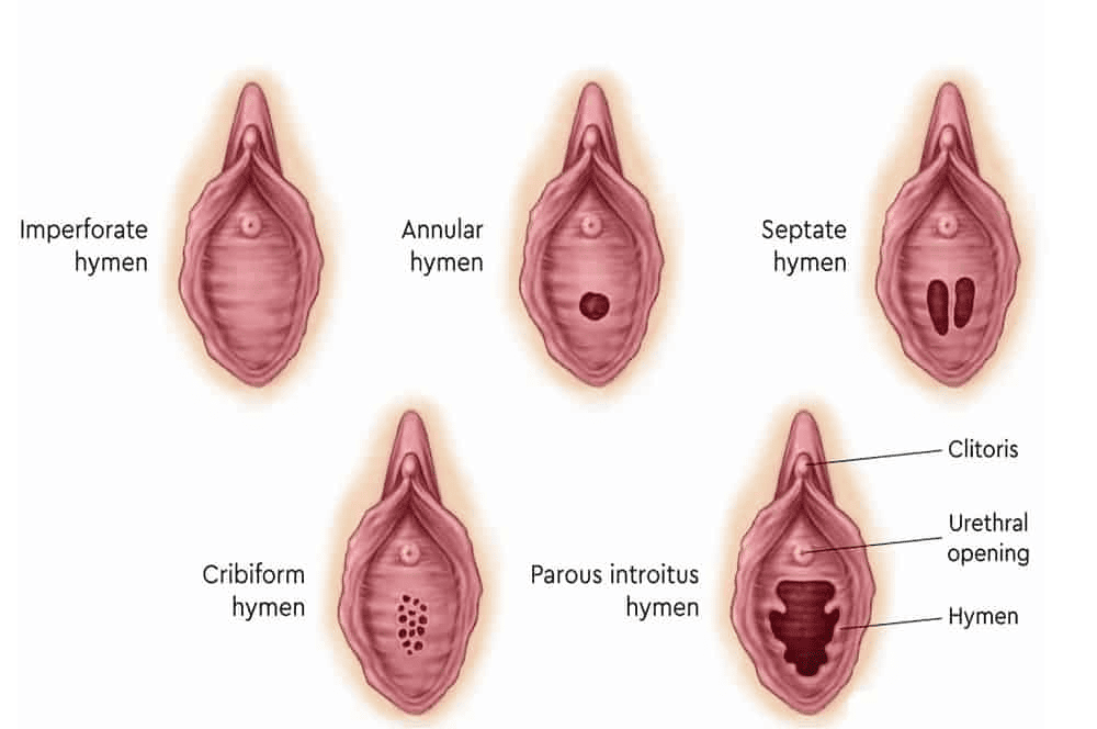 Các loại hình dạng màng trinh