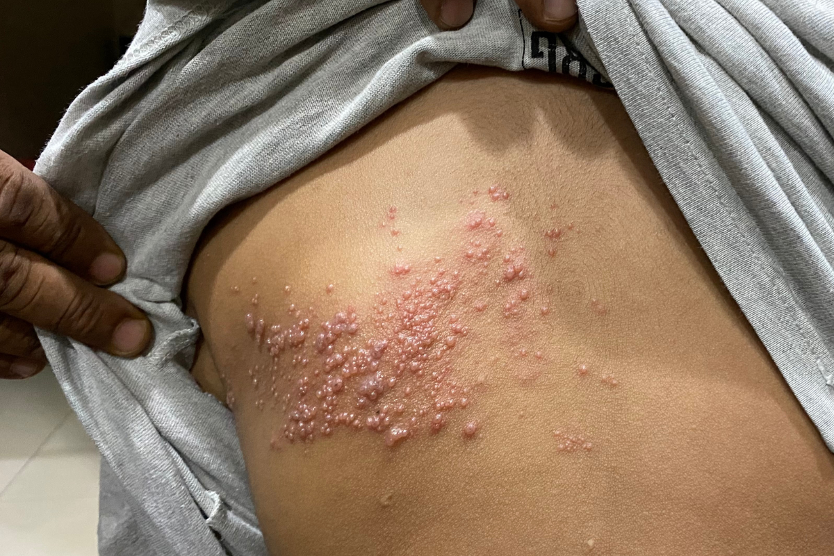 Giời leo ở bụng