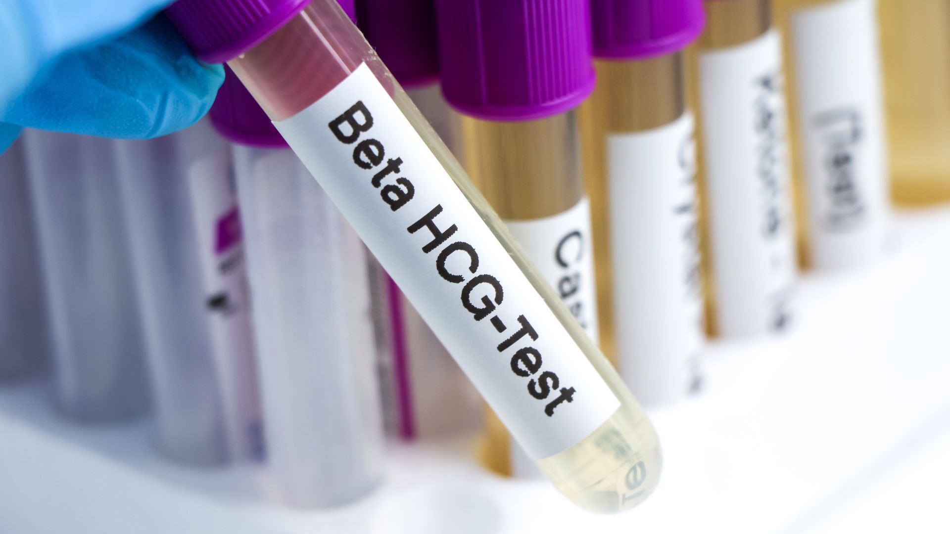 Xét nghiệm Beta hCG