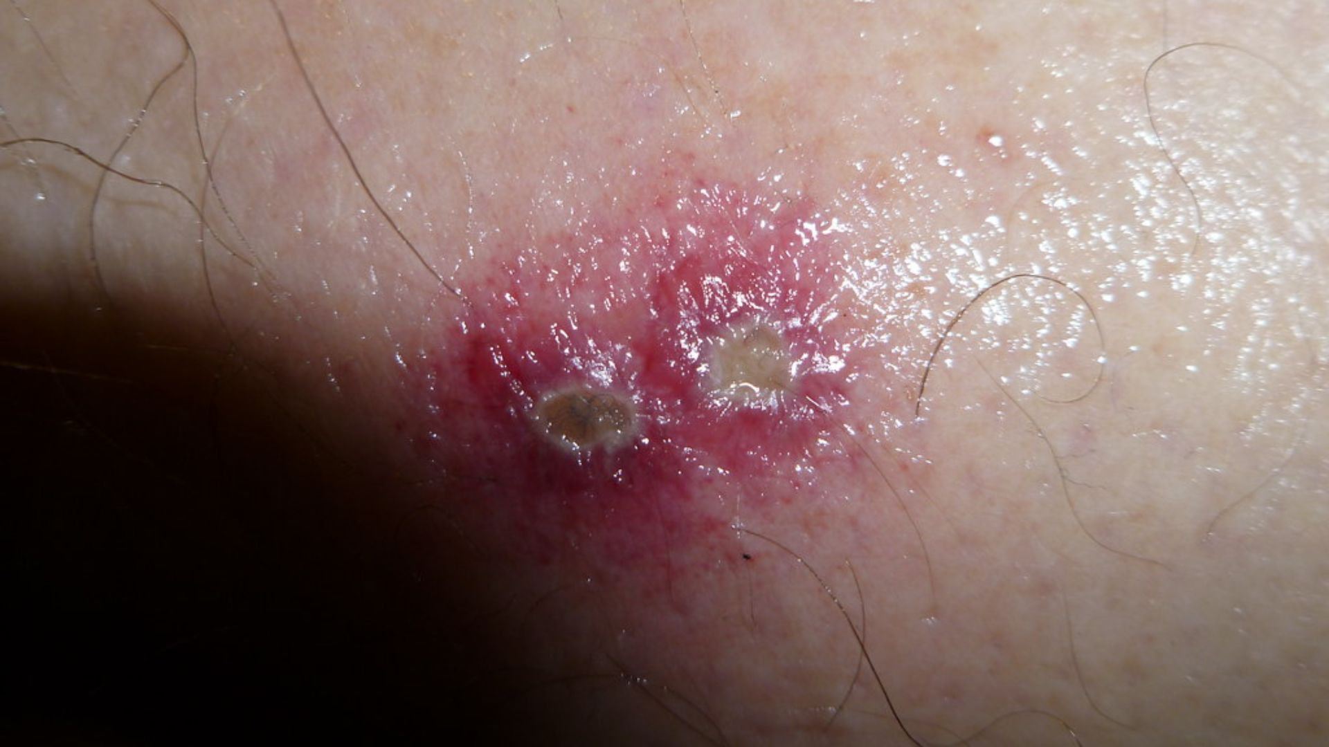 Tổn thương da do kiến ba khoang