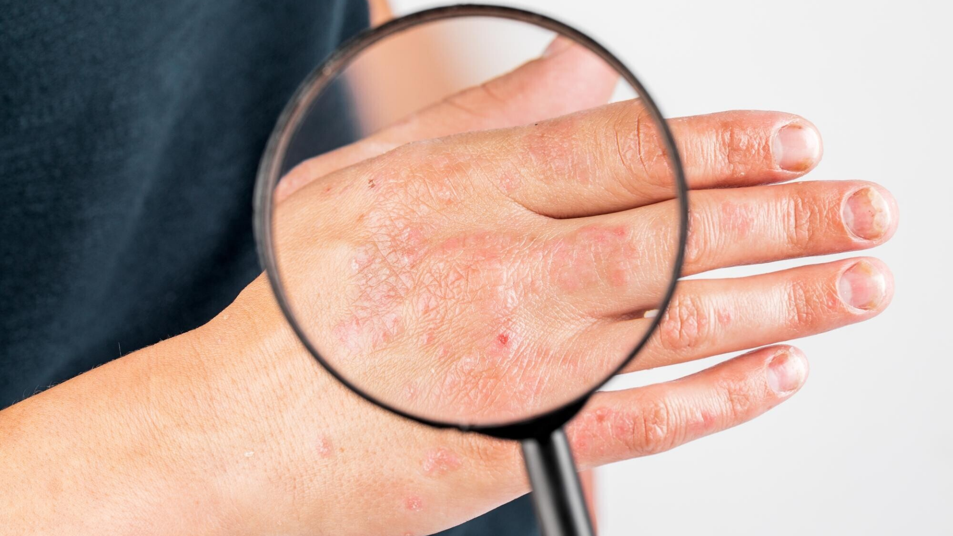 Vùng kín thâm do bệnh da liễu