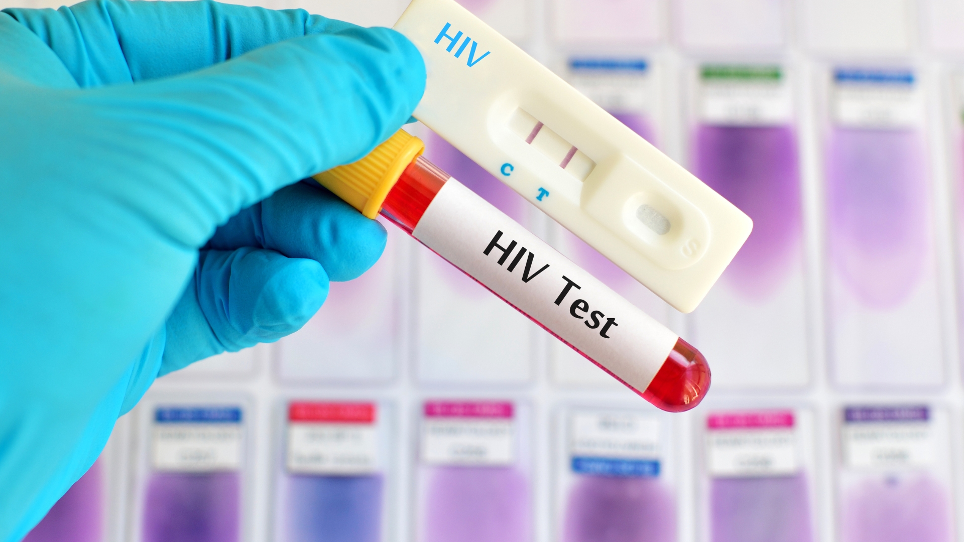 Xét nghiệm HIV sau phơi nhiễm